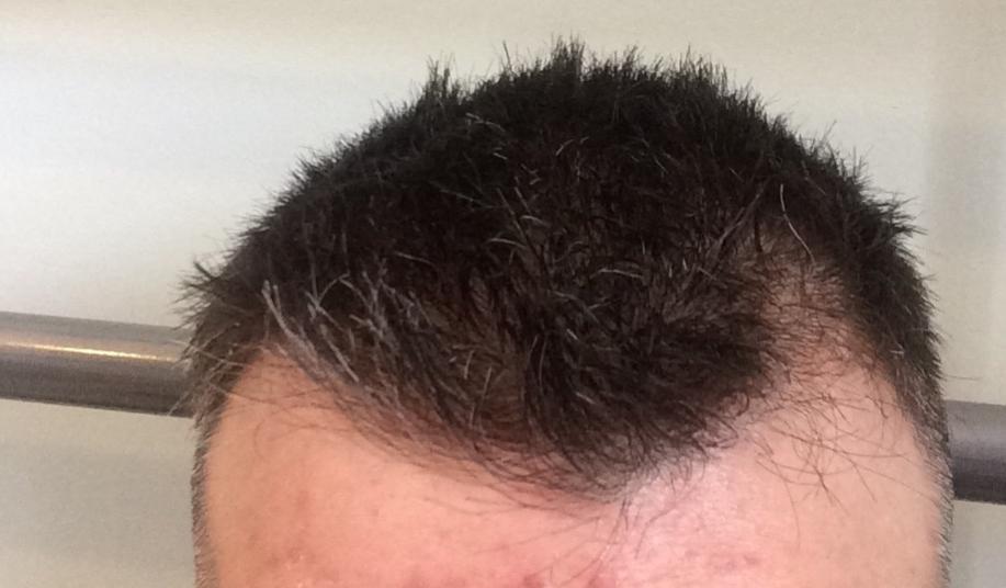 Thinning On Left Side Of Head Only Baldtruthtalk Com