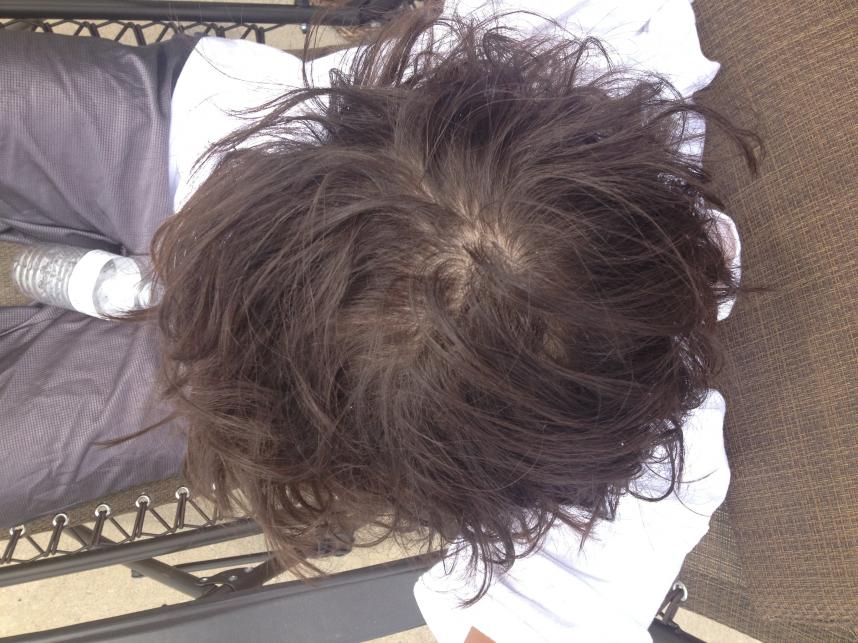 Does My Crown Look Thin Baldtruthtalk Com