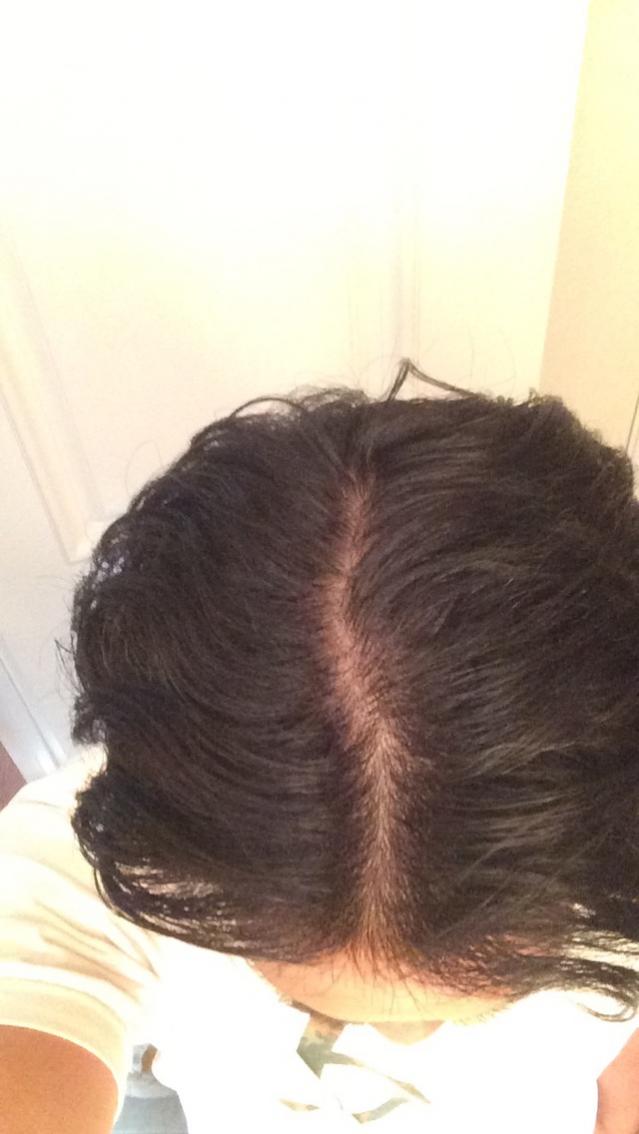 Middle Part Or Thinning Baldtruthtalk Com