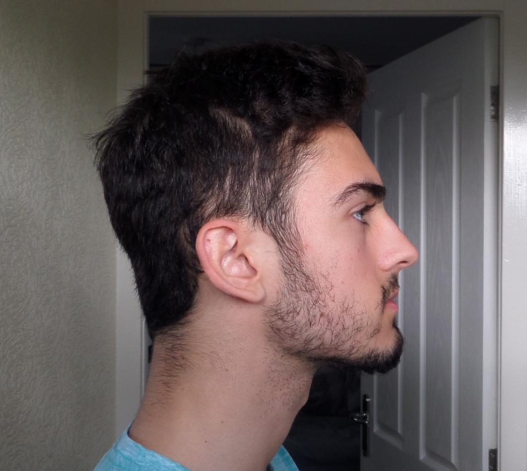 Thinning On Sides Of Head Baldtruthtalk Com