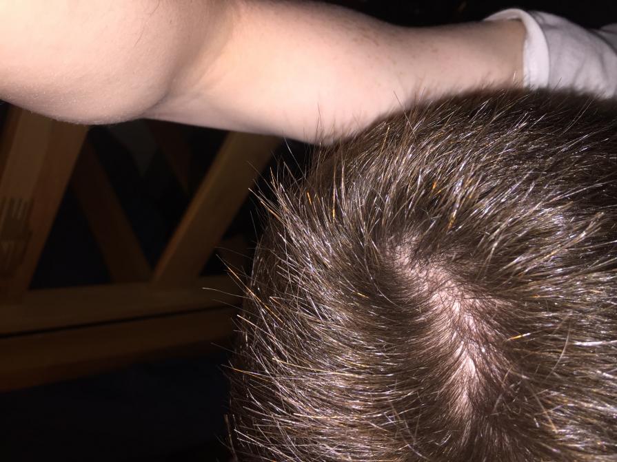 I M 20 Years Old Not Sure Whether My Hair Is Thinning Or Just