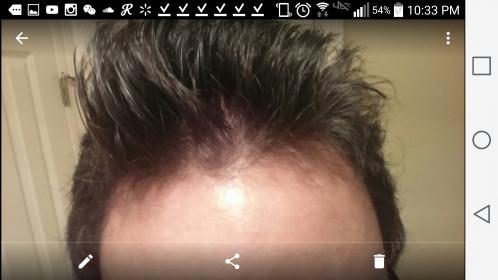 19 Thinning Front Baldtruthtalk Com