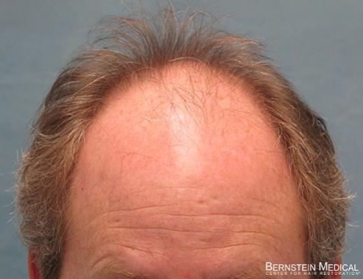 Bernstein Medical's Patient FVR Before Hair Transplant - Detail of Hairline

View his full photoset >> http://www.bernsteinmedical.com/hair-transplant-photos/portraits/patient-fvr/