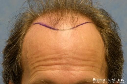 Bernstein Medical's Patient JKJ position of new hairline before hair transplant - Detail of Hairline

View his full photoset >> http://www.bernsteinmedical.com/hair-transplant-photos/portraits/patient-jkj/