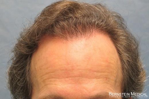 Bernstein Medical's Patient JKJ one year after hair transplant - Detail of Hairline

View his full photoset >> http://www.bernsteinmedical.com/hair-transplant-photos/portraits/patient-jkj/