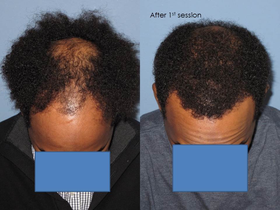 Paul Shapiro, MD
1st Session FUT = 2339 grafts
2nd Session FUT = 1706 grafts
Total for two = 4045 grafts