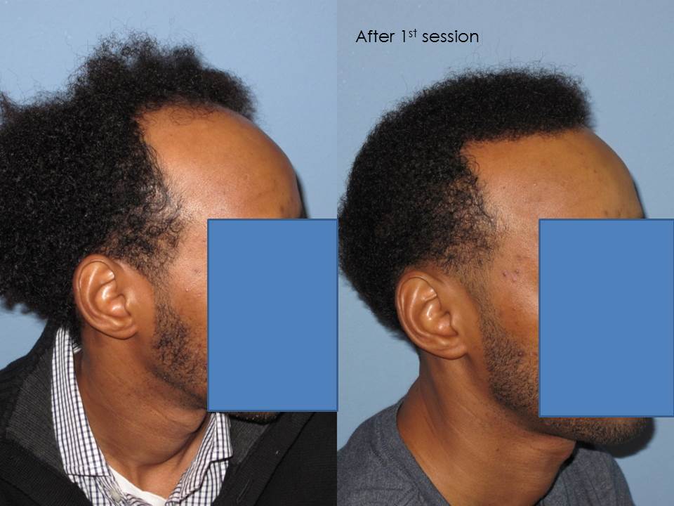 Paul Shapiro, MD 
1st Session FUT = 2339 grafts 
2nd Session FUT = 1706 grafts 
Total for two = 4045 grafts