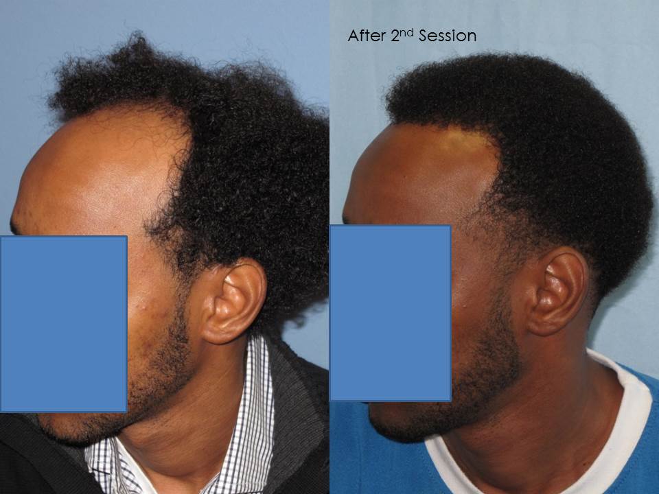 Paul Shapiro, MD
1st Session FUT = 2339 grafts
2nd Session FUT = 1706 grafts
Total for two = 4045 grafts