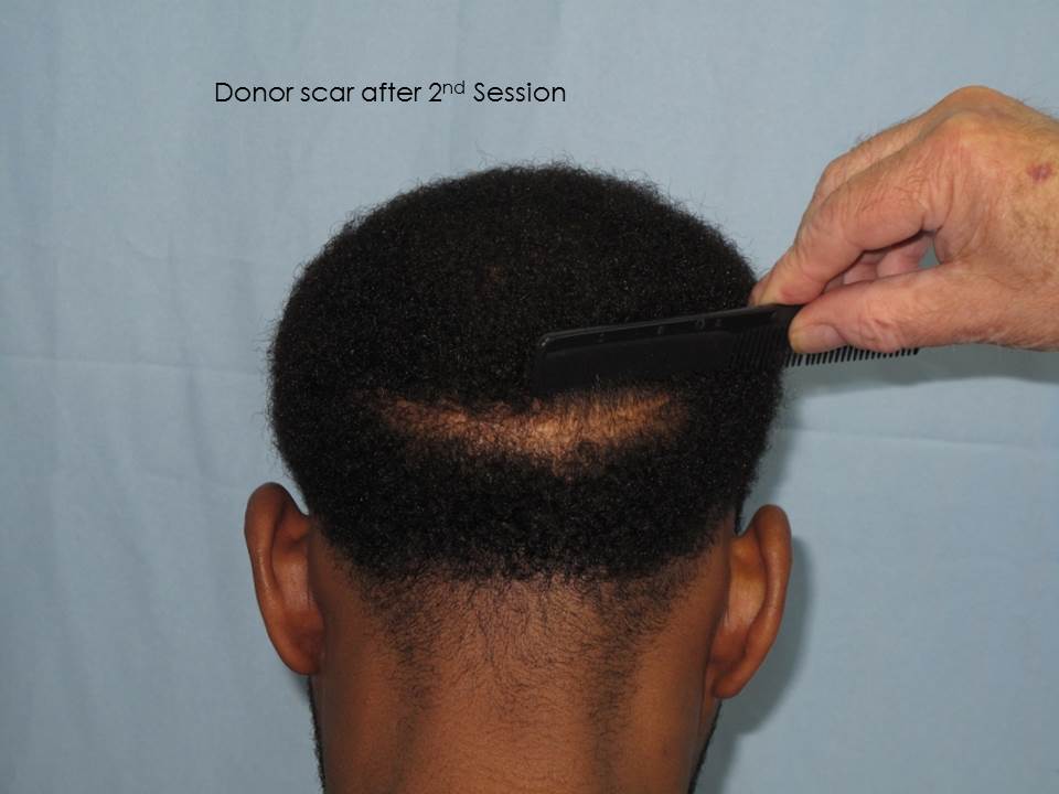 Paul Shapiro, MD
1st Session FUT = 2339 grafts
2nd Session FUT = 1706 grafts
Total for two = 4045 grafts