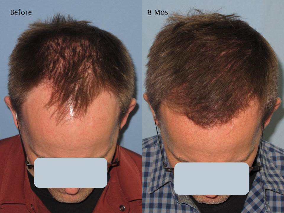 Paul Shapiro, MD
FUE 2226 grafts
8 months post op