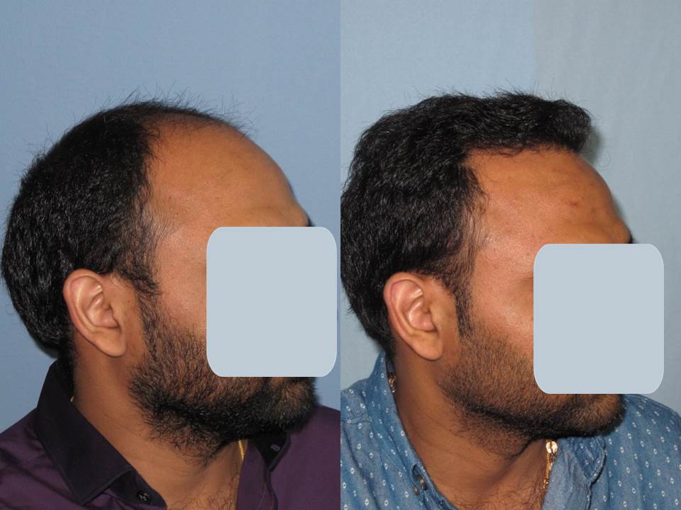 Dr. Paul Shapiro, MD
FUT 4138 grafts
12 months post-op