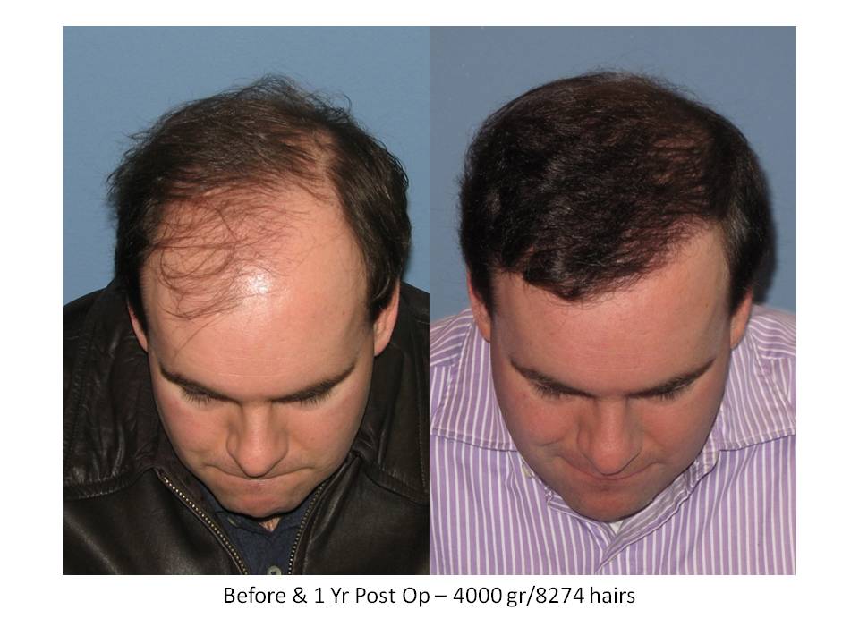 Dr. Paul Shapiro, MD
FUT
4000 grafts/8274 hairs
12 months post-op