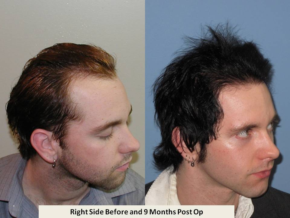 Dr. Paul Shapiro
FUT
2631 grafts/4742 hairs
9 months post-op