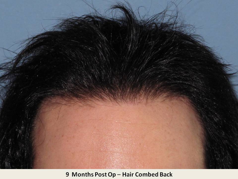 Dr. Paul Shapiro
FUT
2631 grafts/4742 hairs
9 months post-op