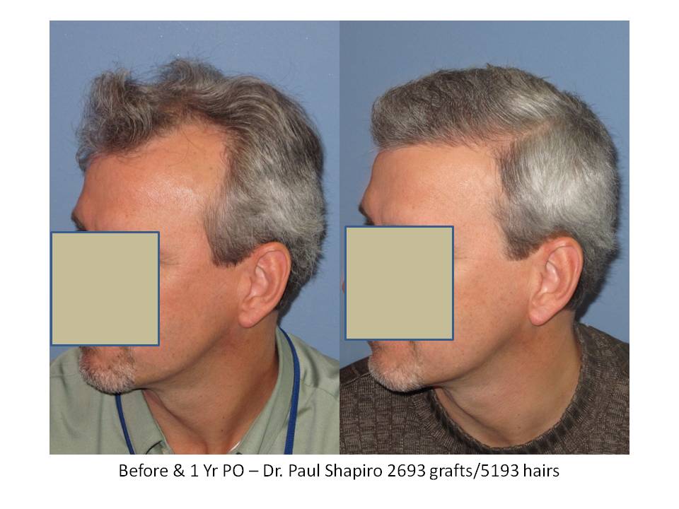 Dr. Paul Shapiro, MD 
FUT
2693 grafts/5193 hairs
12 months post-op