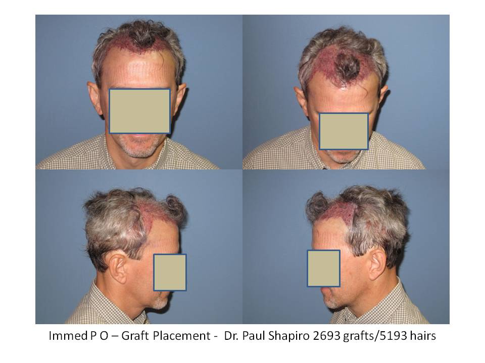 Dr. Paul Shapiro, MD 
FUT
2693 grafts/5193 hairs
12 months post-op