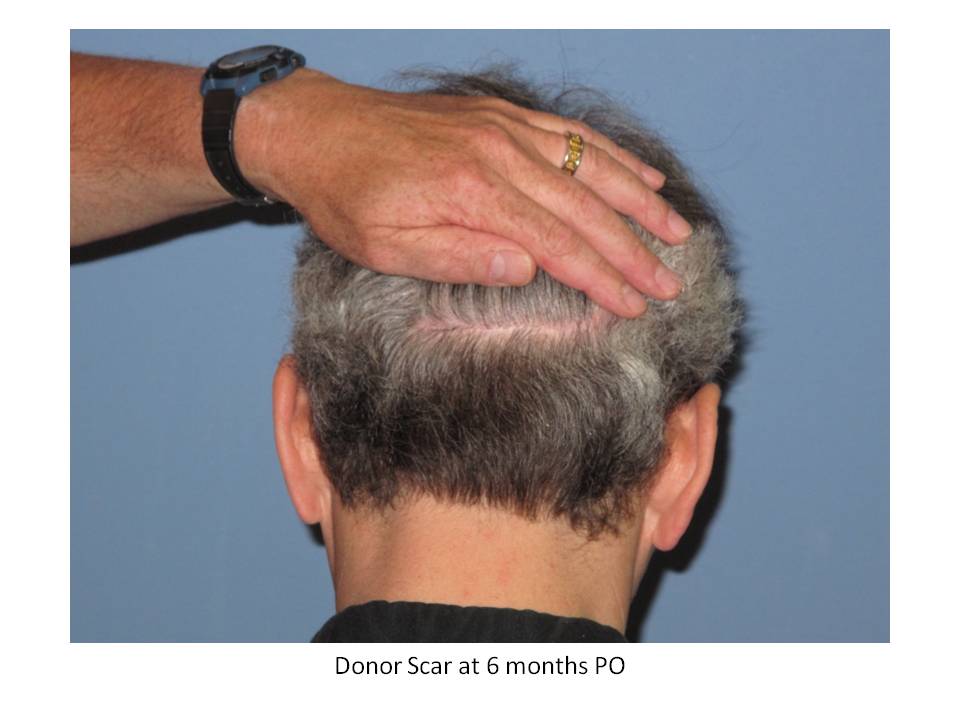 Dr. Paul Shapiro, MD 
FUT
2693 grafts/5193 hairs
12 months post-op