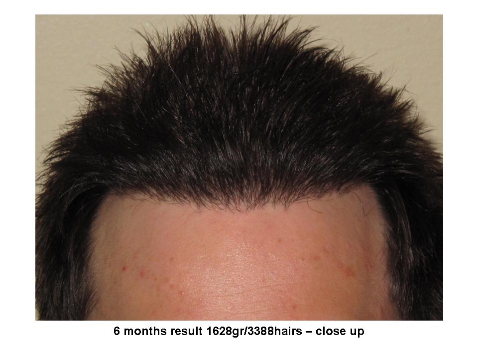 Dr. Paul Shapiro, MD 
FUT 
1628 grafts/ 3388 hairs
6 months post-op