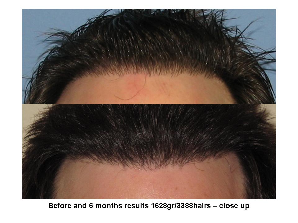 Dr. Paul Shapiro, MD 
FUT 
1628 grafts/ 3388 hairs
6 months post-op