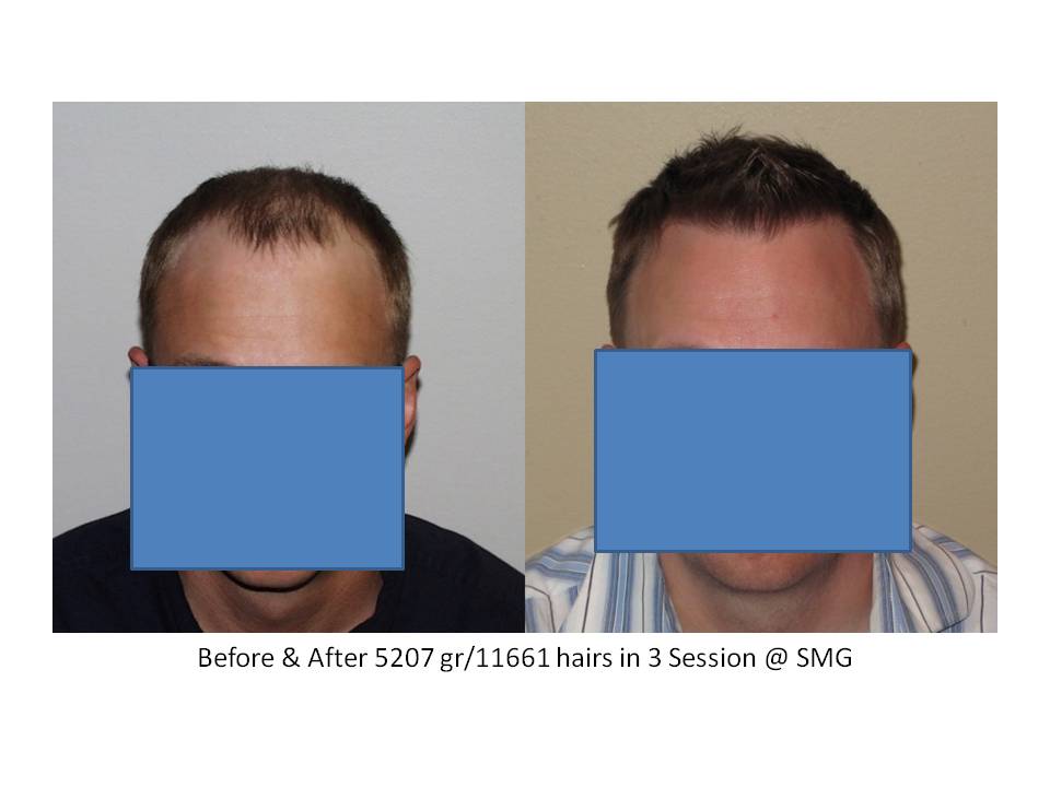 Dr. Paul Shapiro, MD 
FUT 
5207 grafts/ 11,661 hairs
3 surgical sessions
12 months post-op session 3