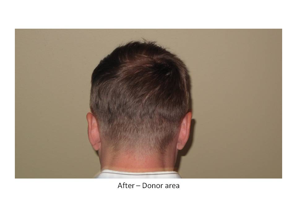 Dr. Paul Shapiro, MD 
FUT 
5207 grafts/ 11,661 hairs
3 surgical sessions
12 months post-op session 3