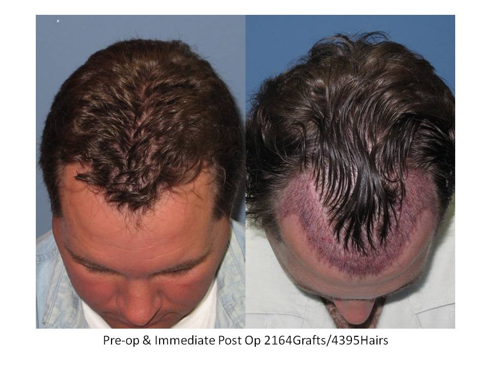 Dr. Paul Shapiro, MD 
FUT
2164 grafts/ 4395 hairs
12 months post-op