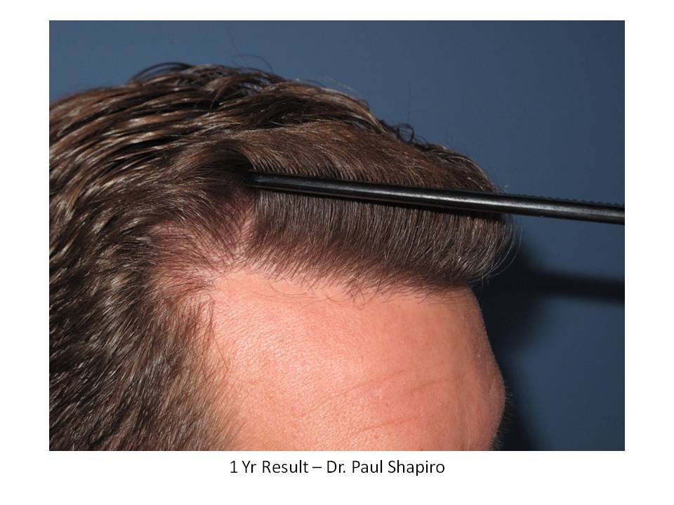 Dr. Paul Shapiro, MD 
FUT
2164 grafts/ 4395 hairs
12 months post-op