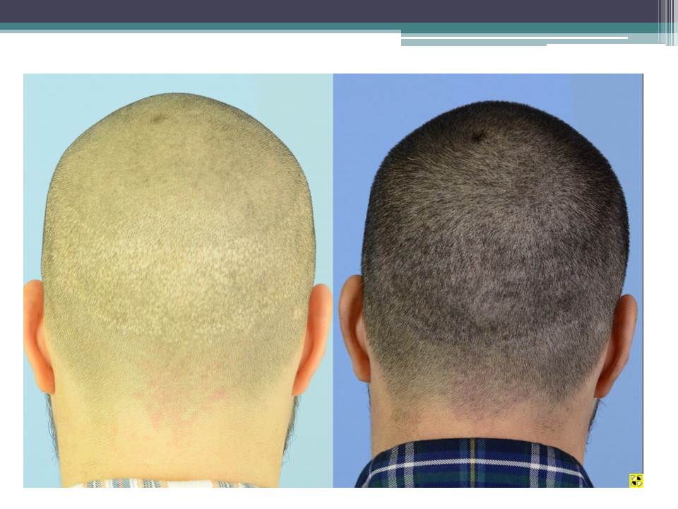 Волосы форум мужчины. Пересадка волос микро панчами. Scalp Surgery. Метод fue пересадка через 4 недели.