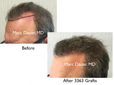 Click image for larger version

Name:	Hair Transplant Slides copy21.002.jpg

Size:	14.0 KB
ID:	44273