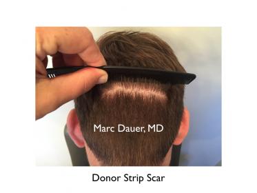 Click image for larger version

Name:	Hair Transplant Slides copy12.005.jpg

Size:	11.5 KB
ID:	45559