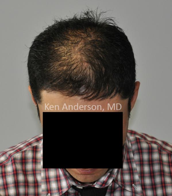 BEFORE Anderson Center for Hair Restoration Transplant