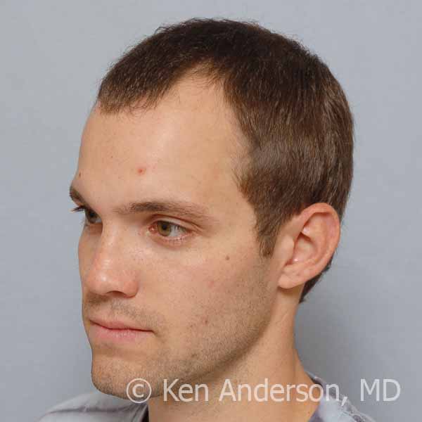 Dr. Ken Anderson - 32 year old Norwood 3 - ARTAS and PRP with ACell - 14 month post-procedure results