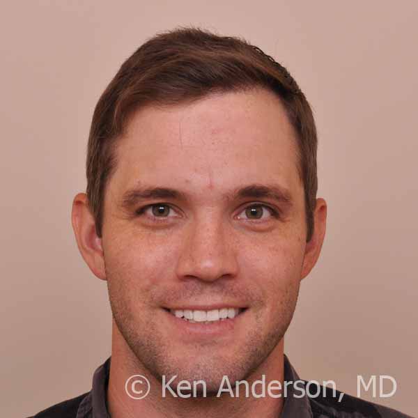 Chris Markham
Age: 32
Norwood: 3

Clinical History:
Chris Markham first came to see me when I was Chief of Hair Restoration Surgery for Emory Healthcare in 2010, when he was 26 years of age.  He felt he was looking older than 26 when we met, and he was unsatisfied with how hair loss affected his confidence.  He felt his hair loss was detrimental to him at work, and also limited his social life.  He told me he was afraid to ask women out for a date, and that his hair loss was very distressing to him in general.  We started with some conservative therapy (Propecia, Rogaine) for about a year. In 2011 Chris decided to have his FUT procedure with me at Emory. 

Medical and Surgical: 
Chris has had a total of two procedures.  Initially he had a linear strip procedure in November of 2011, in which 1,121 FUT grafts were transplanted to his frontal hairline and bilateral temporal recessions.  He was very pleased with this result, and kept up with the Propecia and Rogaine.   Chris mentioned that he was amazed at how painfree the entire process was, and that desired to have a second procedure to enhance his results.  His second procedure was performed in September of 2013 using the ARTAS Robotic Hair Transplant system at my new center, the Anderson Center for Hair, and he received 796 FUE grafts to the frontal hairline and bilateral temporal recessions. He also received a platelet-rich plasma (PRP) with ACell treatment at the time of his second procedure.

Results:
These pictures were taken 14 months following his ARTAS FUE procedure, and 3 years following his original FUT procedure, in November of 2014. Chris is thrilled with the results, and states that he is a different person with his new hair.  He has a fiance and is getting married later this year.  He continues the Propecia and Rogaine therapy to curtail future hair loss.