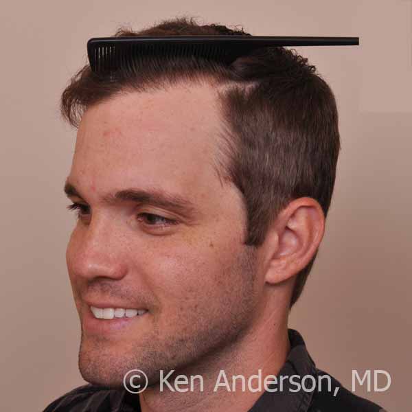 Dr. Ken Anderson - 32 year old Norwood 3 - ARTAS and PRP with ACell - 14 month post-procedure results