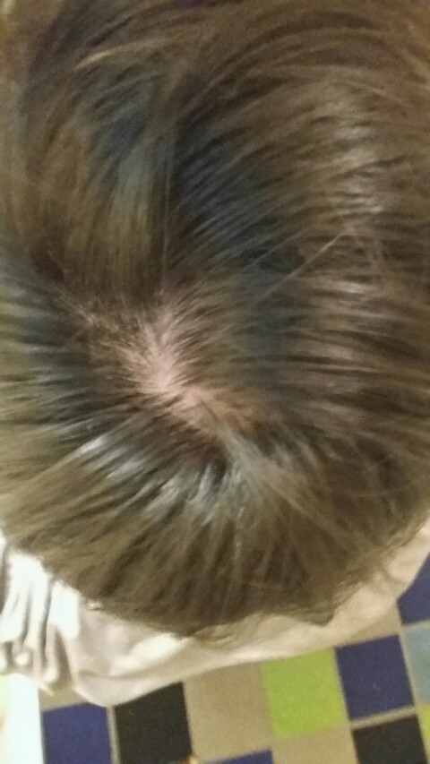 Help Is My Crown Normal Baldtruthtalk Com