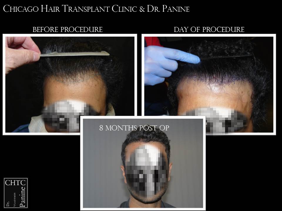 Panine Md Chicago Hair Transplant Clinic Fue Patient S Results 8 Months Post Op Baldtruthtalk Com