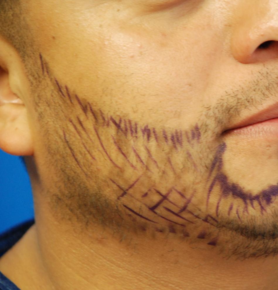 Picture 11 of 12 from Facial Hair 1670 Follicles