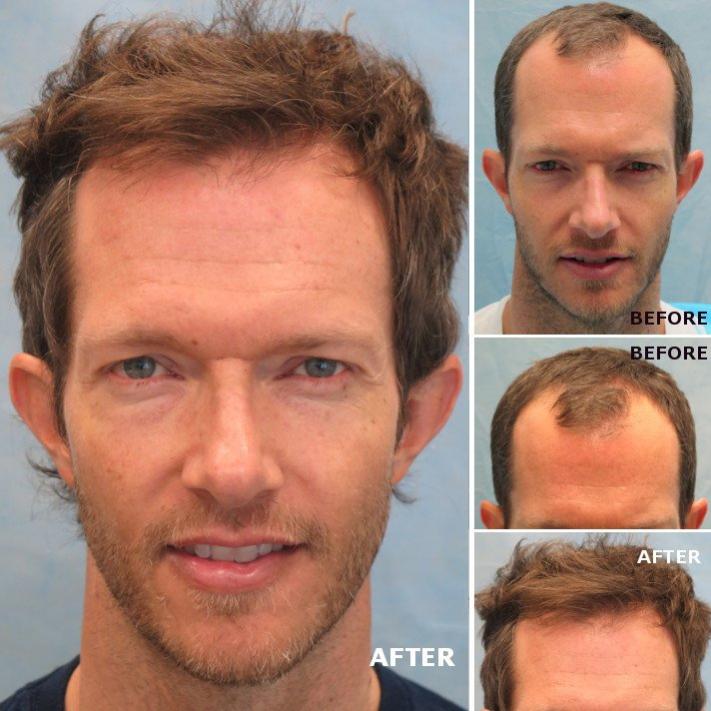 Patient GKL / Results 15 months after 1,845 grafts