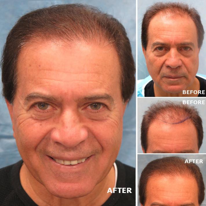 Patient HNZ / 2,178 grafts