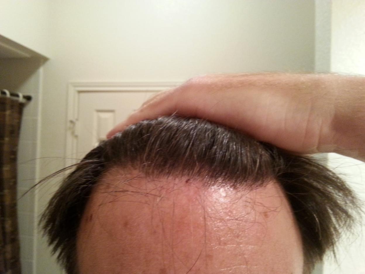 Click image for larger version

Name:	Hairline13months1.jpg

Size:	84.3 KB
ID:	48042