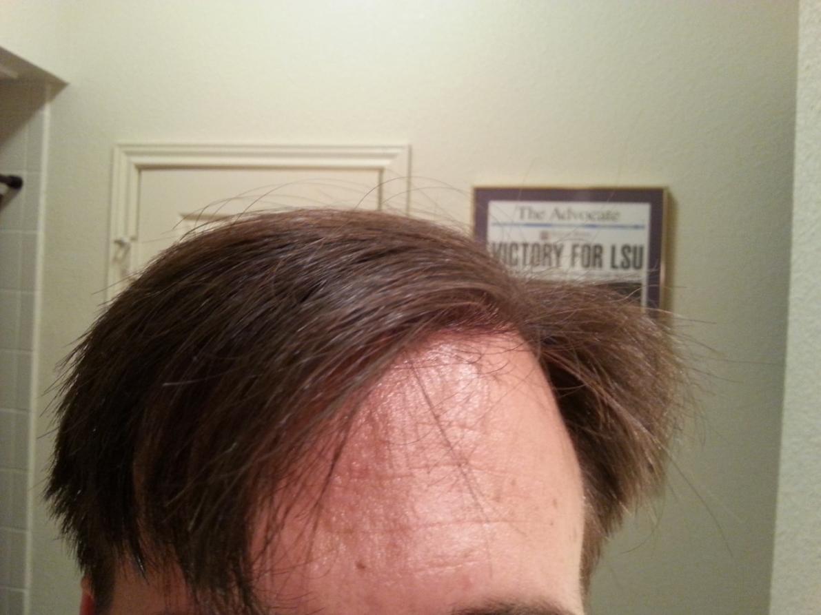 Click image for larger version

Name:	Hairline13months2.jpg

Size:	86.8 KB
ID:	48043