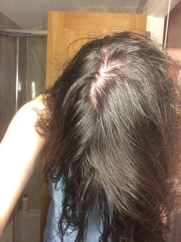 Am I Balding Long Hair Guy Here Baldtruthtalk Com