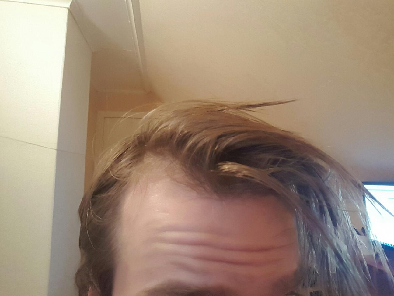 Receding hairline at 18