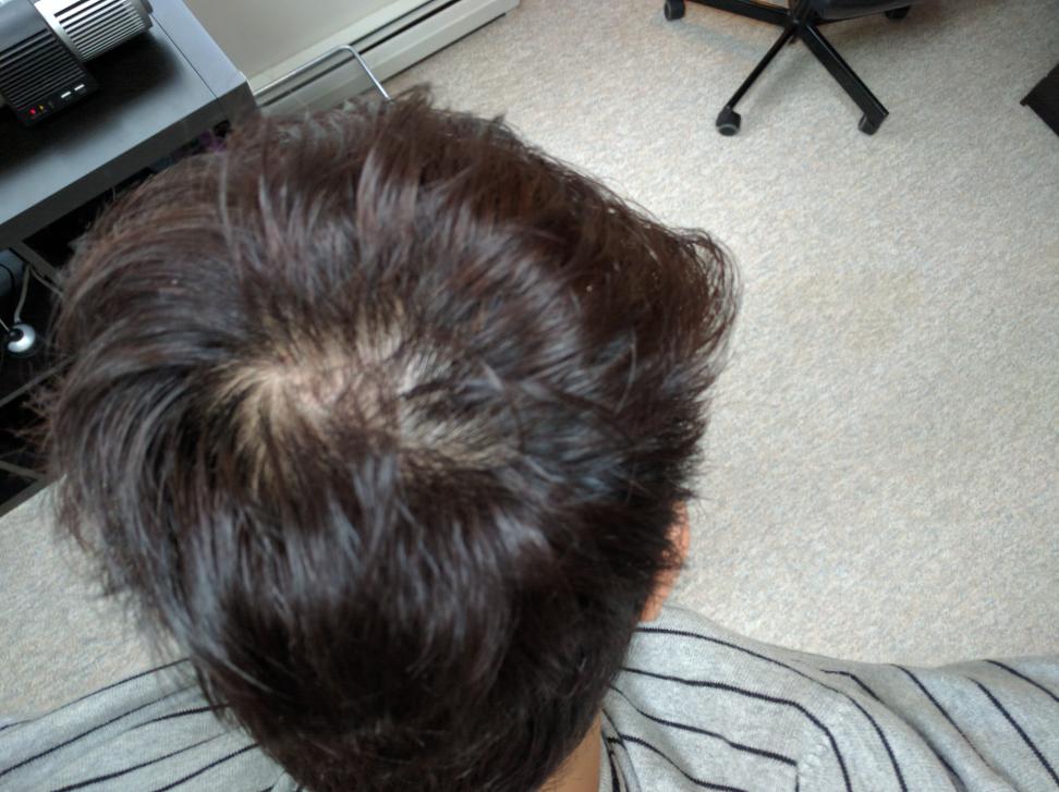 Am I Balding On The Crown Baldtruthtalk Com