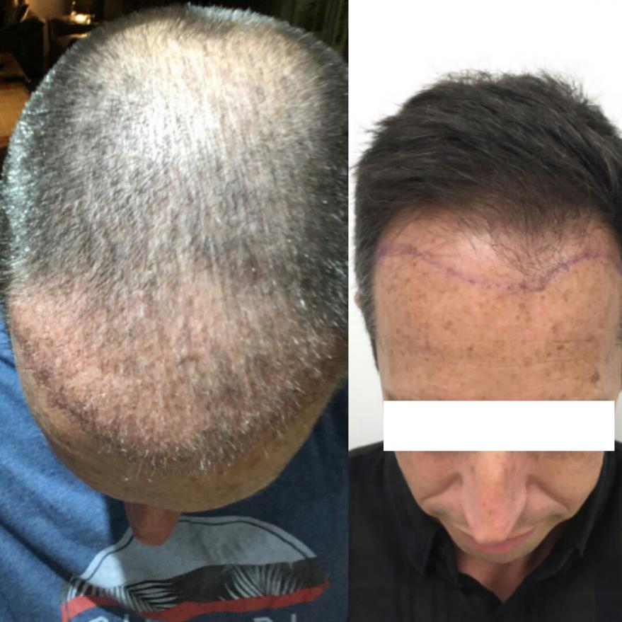 My FUE hair transplant story at Adem & Havva in Istanbul 