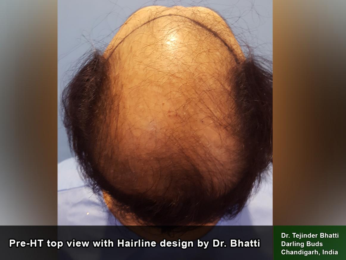 My Hair Transplant with Dr. Tejinder Bhatti 