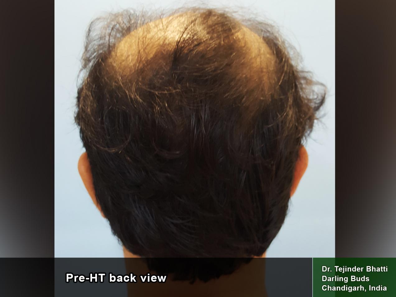 My Hair Transplant with Dr. Tejinder Bhatti 