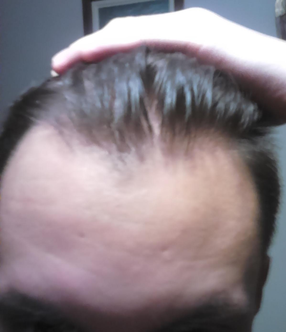 Hairline 18 receding at Receding hairline