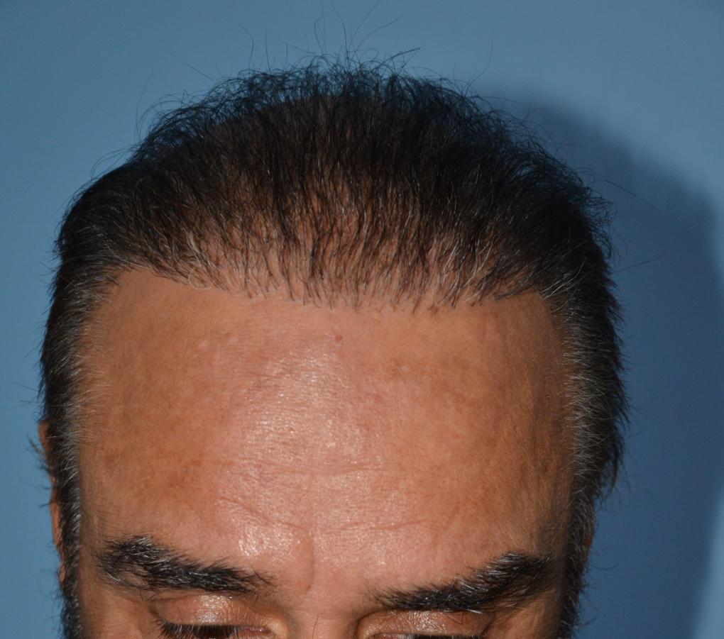 Click image for larger version

Name:	Darling Buds Hair transplant clinic India (6).jpg

Size:	91.3 KB
ID:	50293