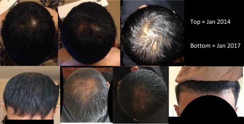 Hairloss Battle Story 3 Years Pics Q S Need Answering Fin